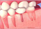 インプラント、東京都日野市| 日野旭が丘歯科+Kids Dental、日野旭ヶ丘歯科